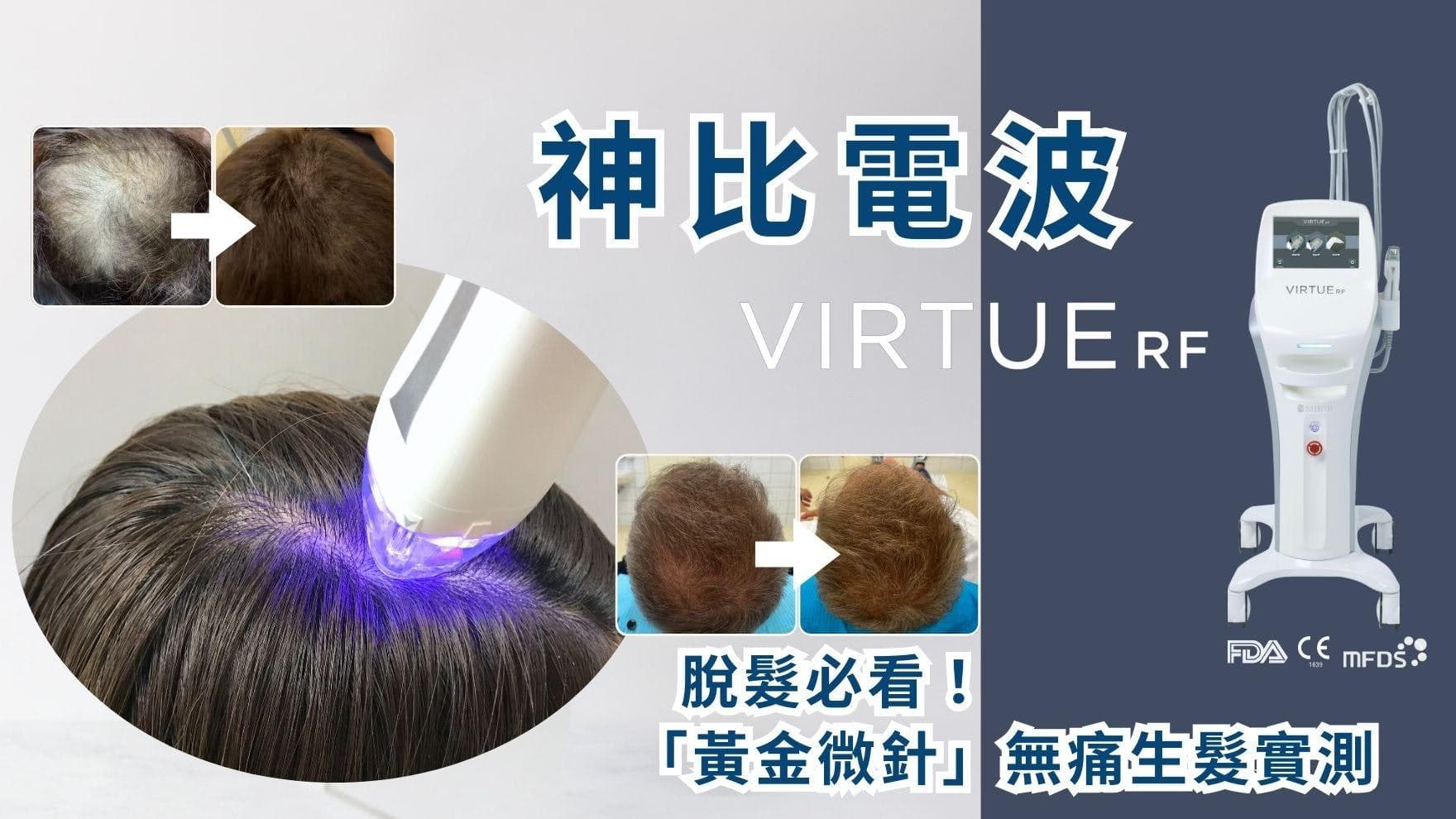 Defeat Hair Loss with Virtue RF: A 90-Day Painless Regrowth Trial